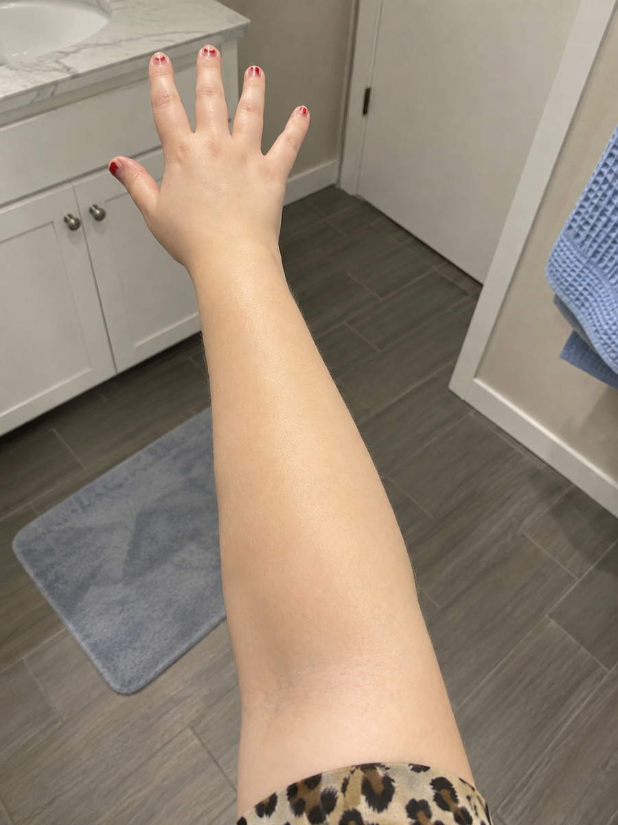 After applying Verlyn