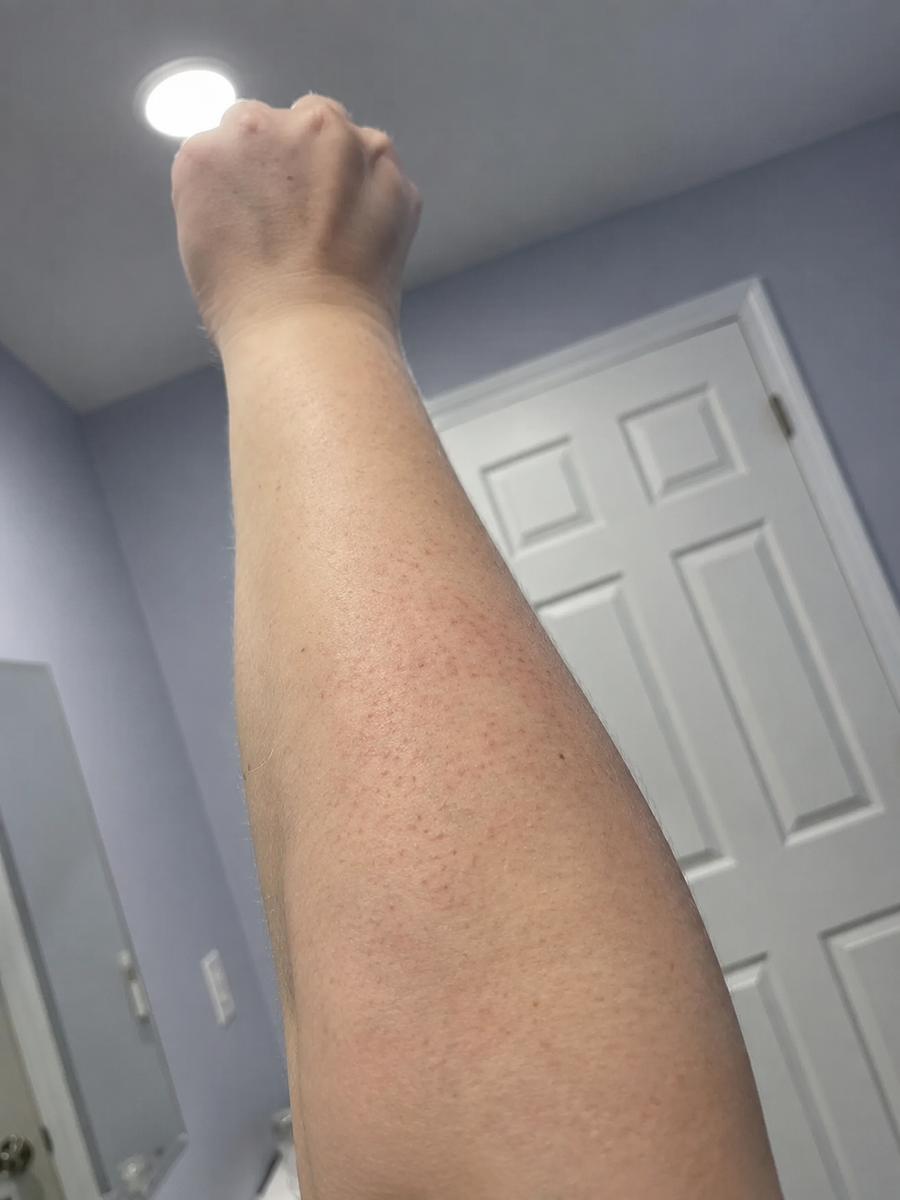 Before applying Verlyn