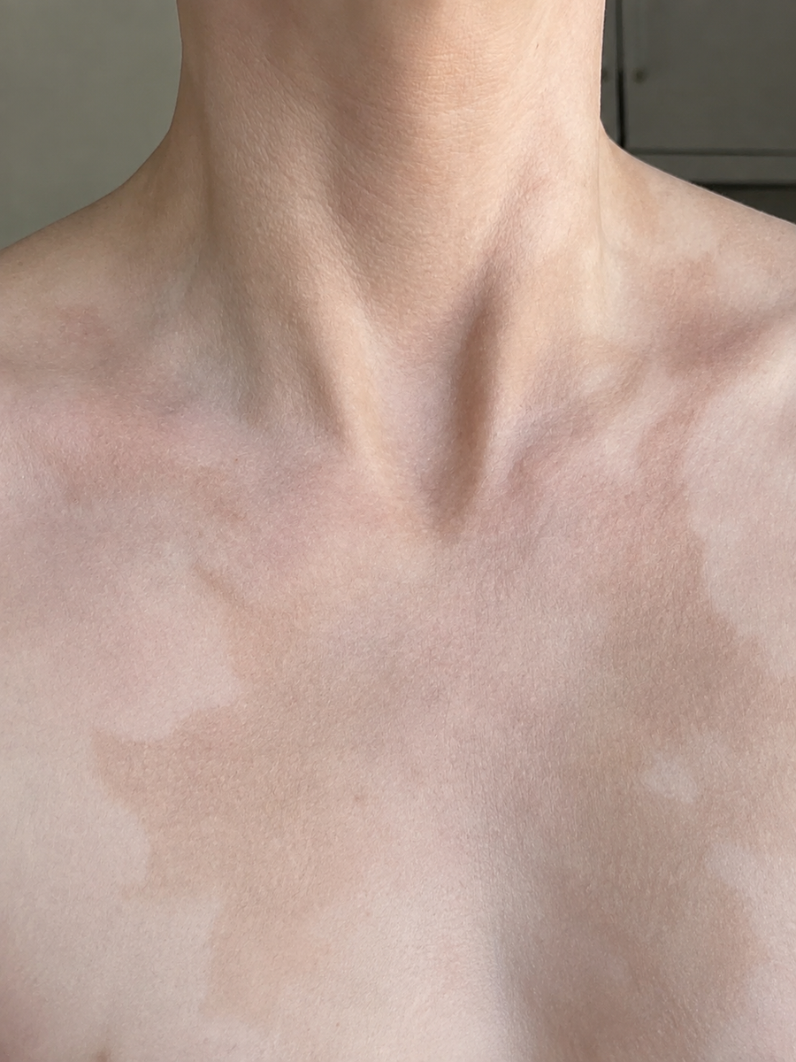 Before applying Verlyn