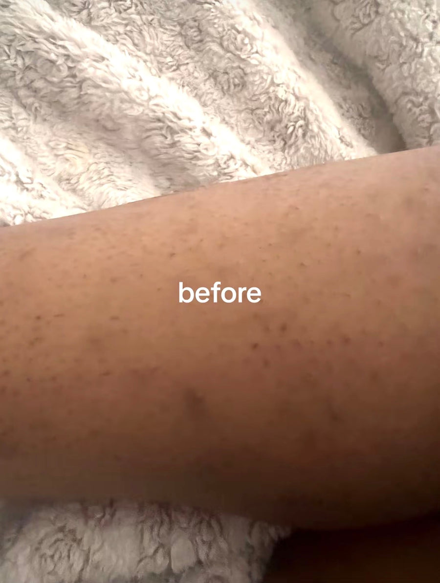 Before applying Verlyn