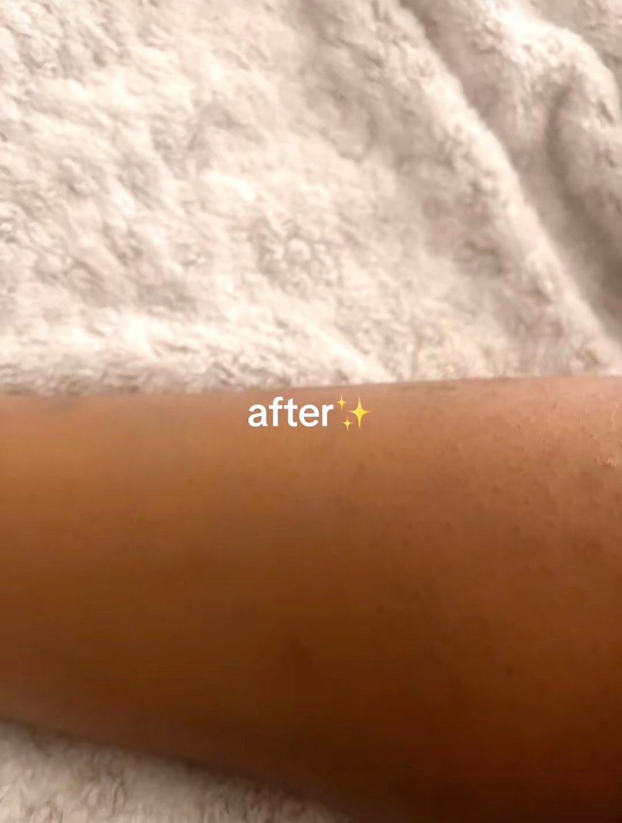 After applying Verlyn